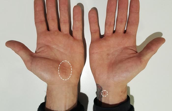 Comparativa de la cicatriz en cirugía abierta (izda) frente a la ecoguiada (dcha)