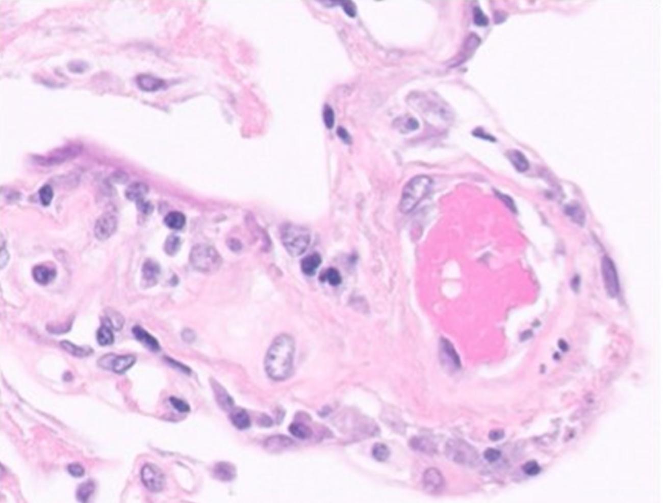 Trombo detectado en una arteriola pulmonar de un fallecido por Covid-19. 